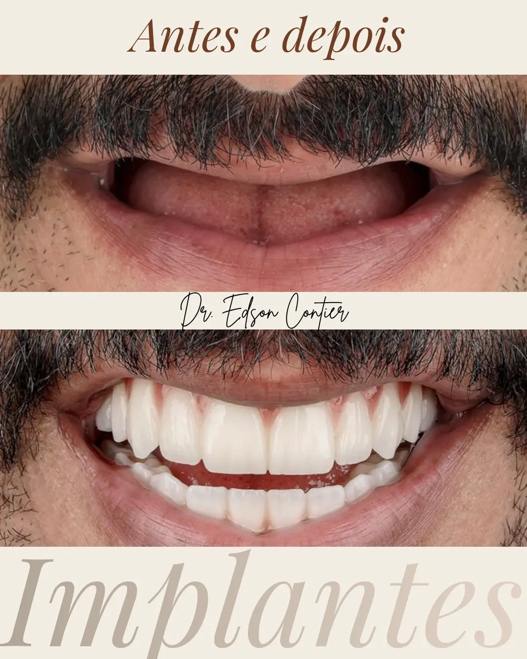 Antes e depois — Implantes