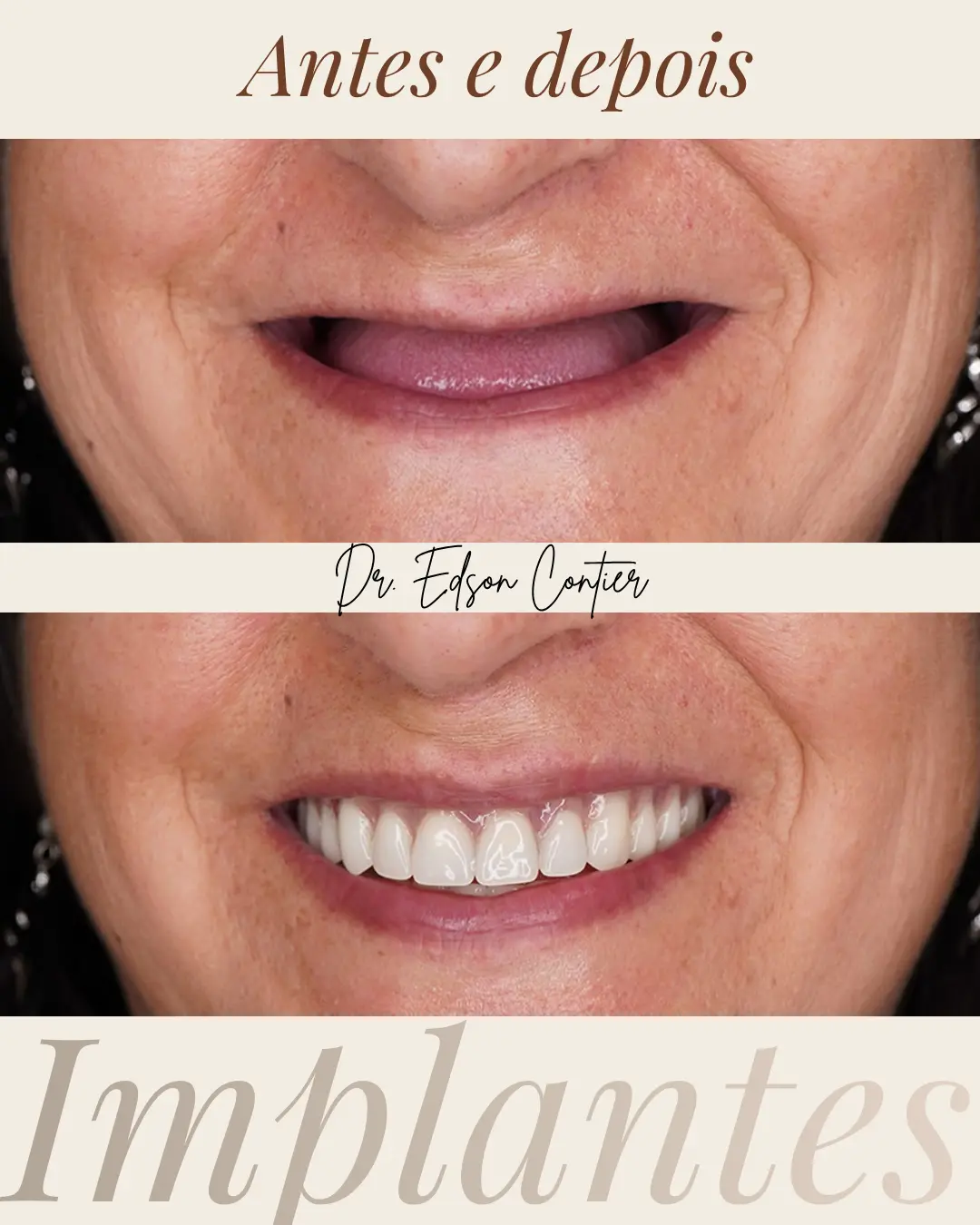 Antes e depois — Implantes