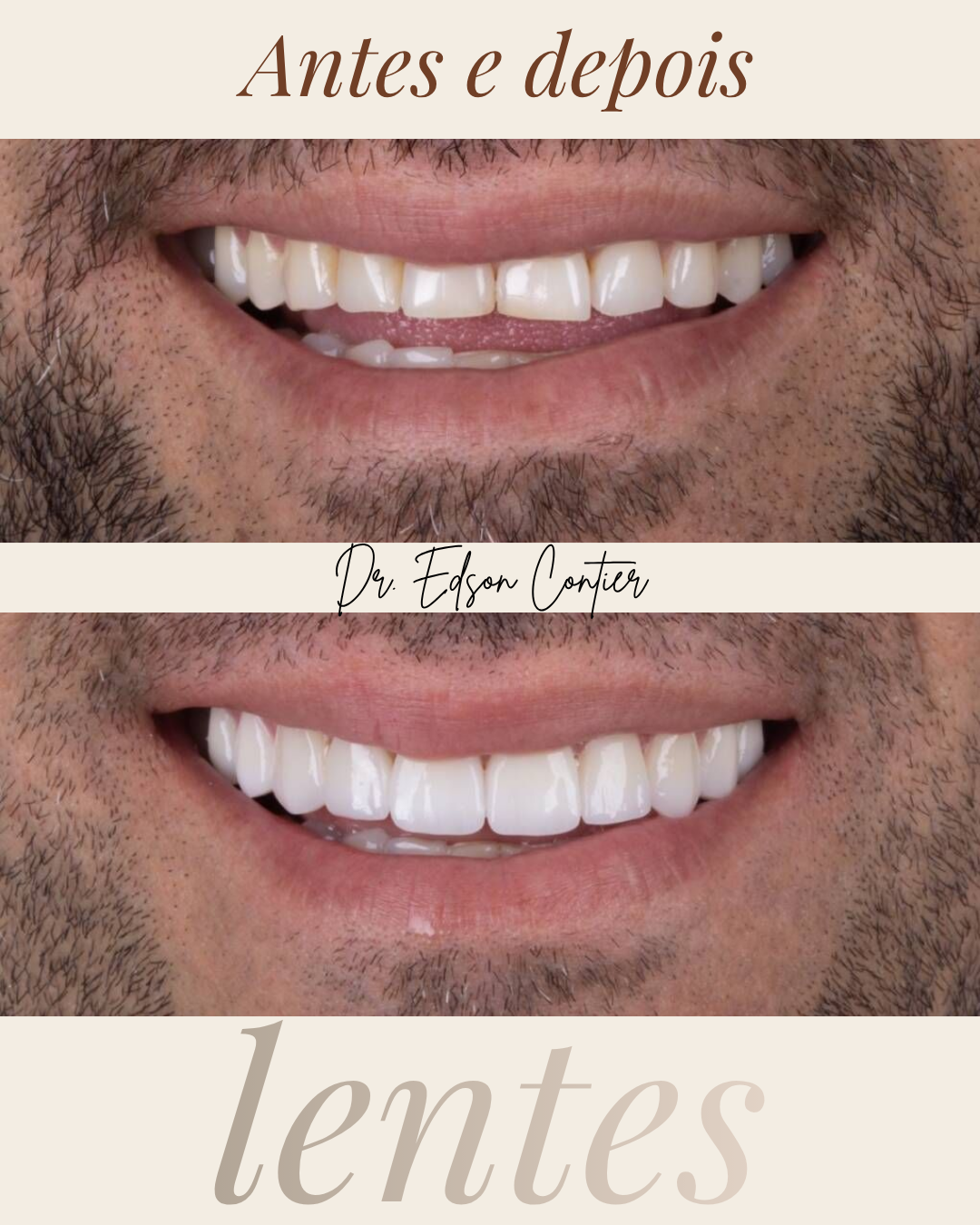 Antes e depois — Lentes