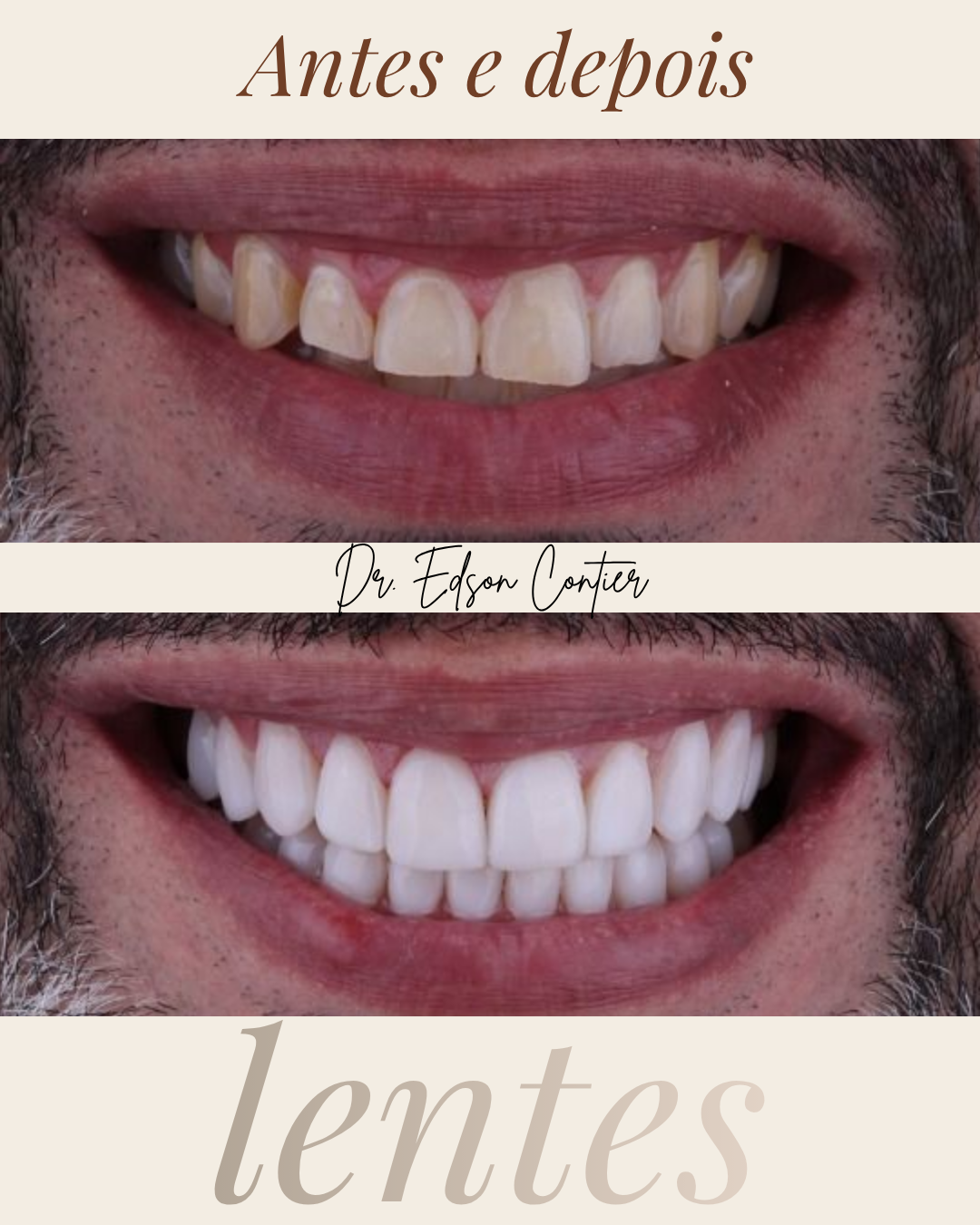 Antes e depois — Lentes