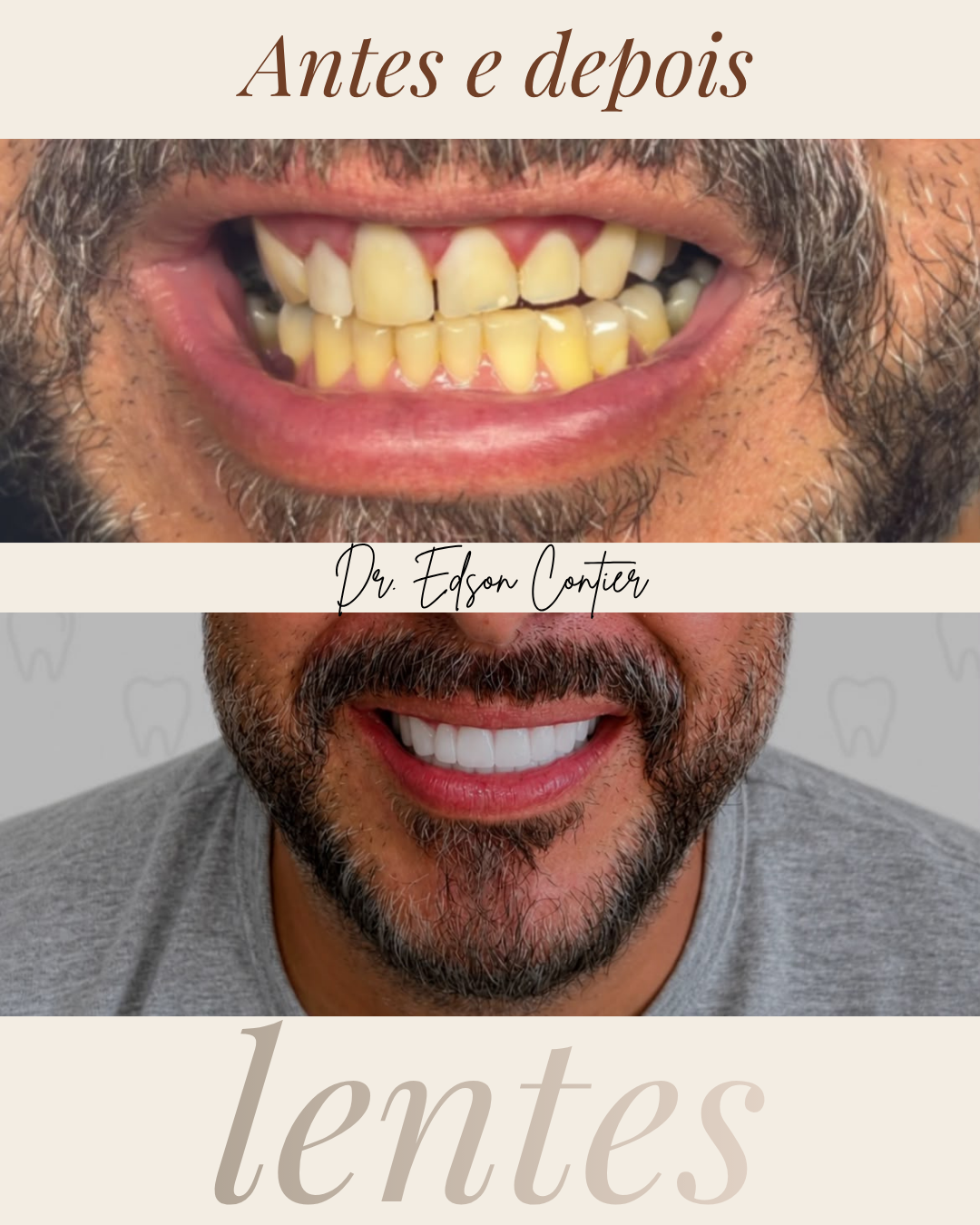 Antes e depois — Lentes