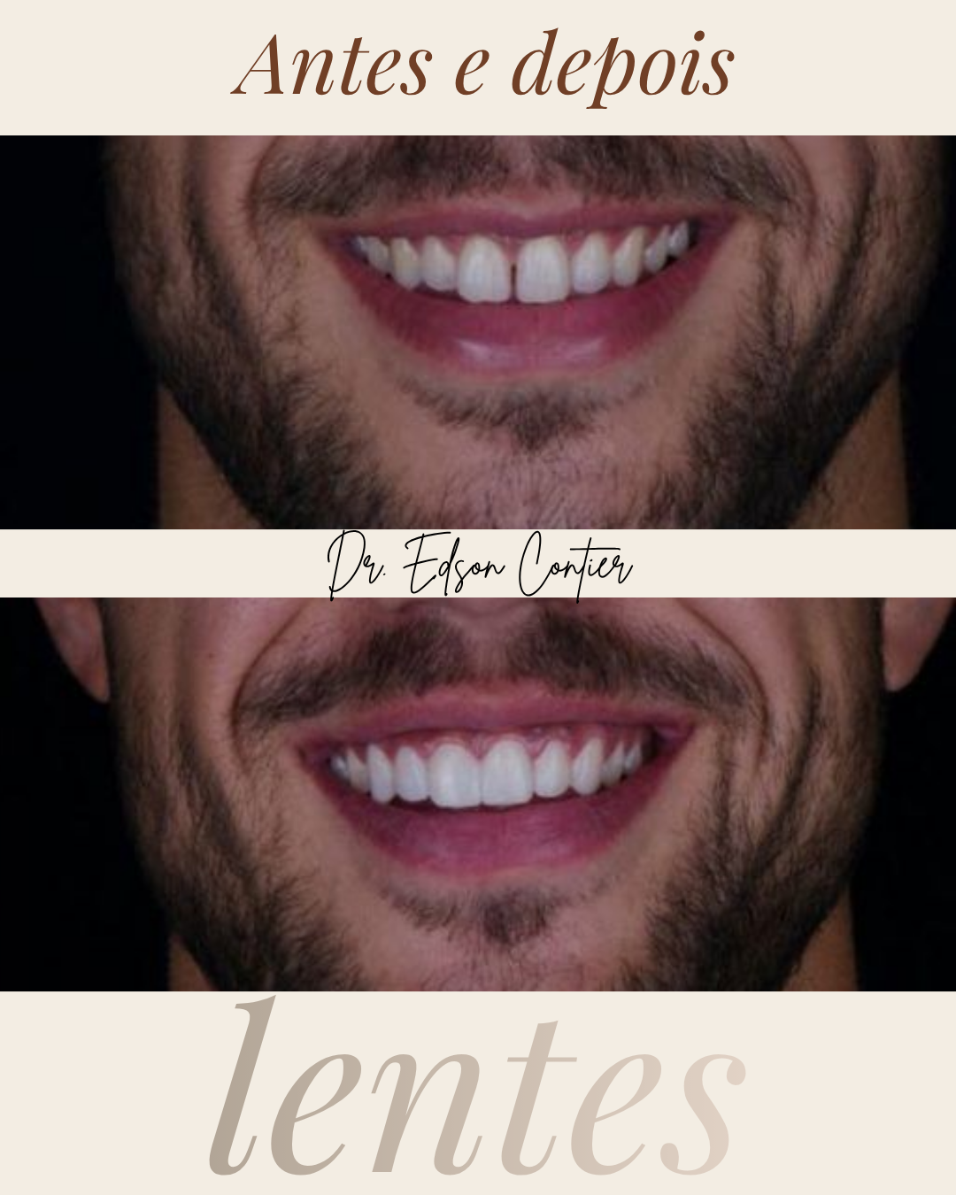 Antes e depois — Lentes