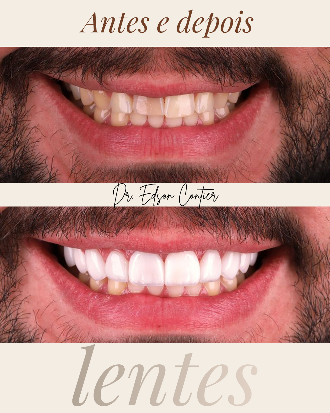 Antes e depois — Lentes