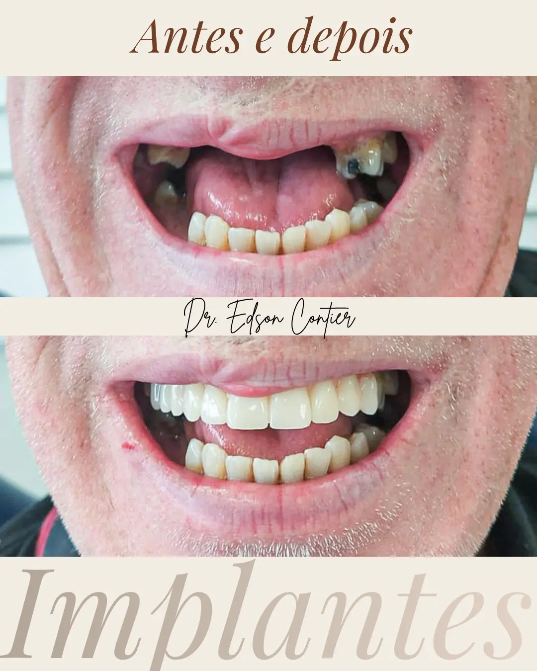 Antes e depois — Implantes