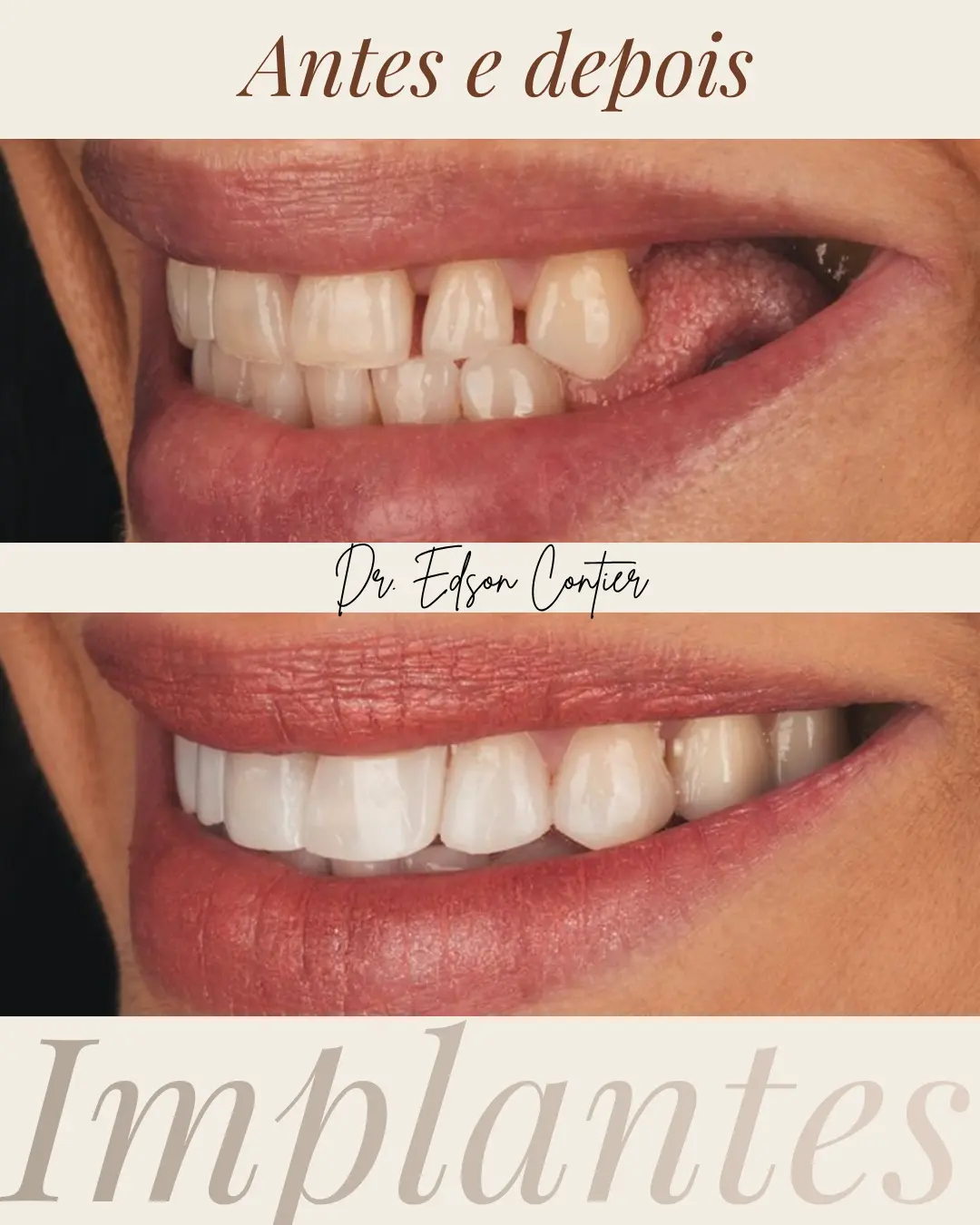 Antes e depois — Implantes